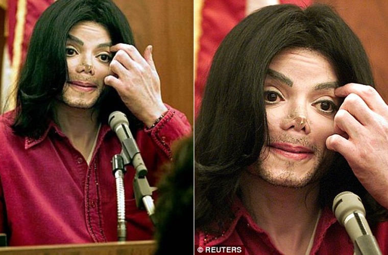 Khuon mat Michael Jackson bi pha hong the nao sau dao keo-Hinh-6